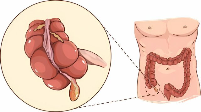 Appendicitis