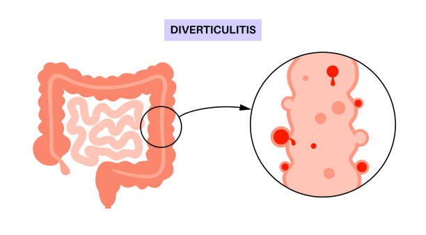 Diverticulitis