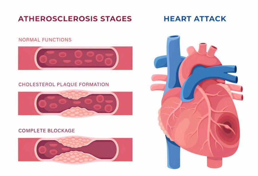 Heart Attack