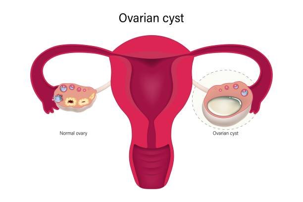 Ovarian cyst with female reproductive system. Female ovarian disease vector.