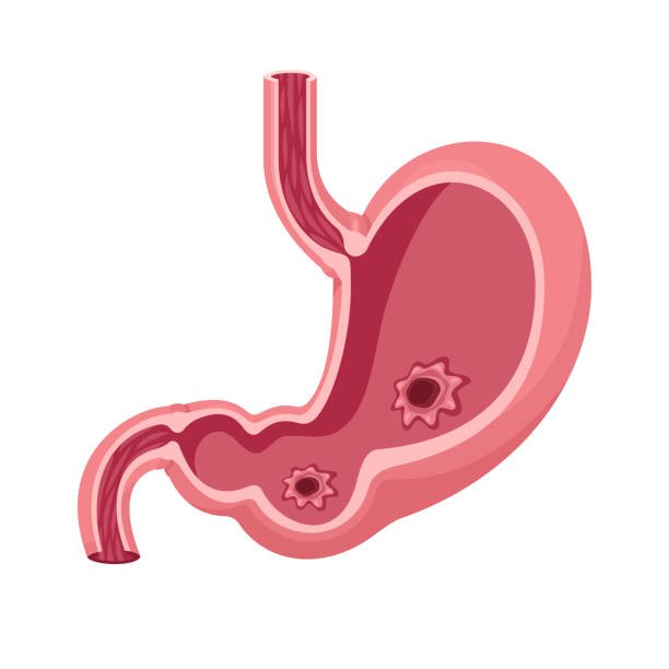 Stomach Ulcer