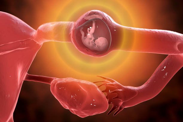 Ectopic Pregnancy