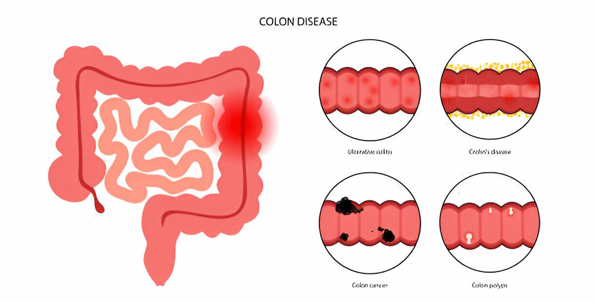Colon Pain