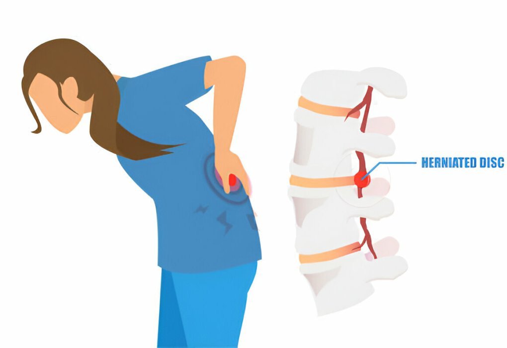Herniated Disc Pain