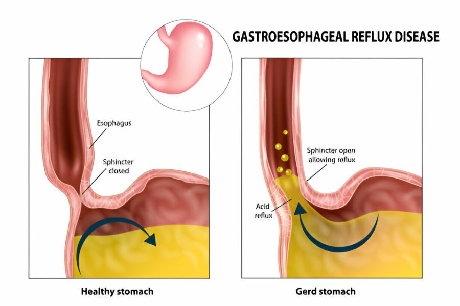 gastroesophageal reflux disease