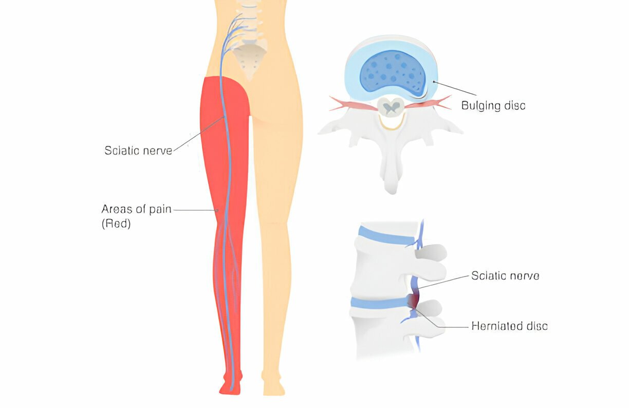 Sciatica Pain