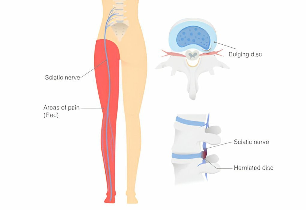 Sciatica Pain