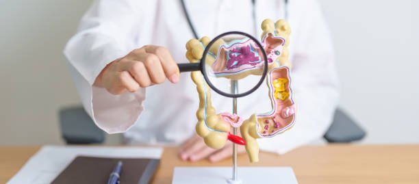Colon Cancer