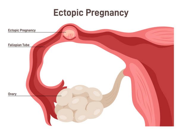 Ectopic Pregnancy