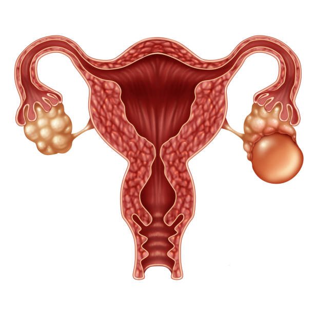 ovarian-cyst