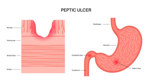 Peptic Ulcer