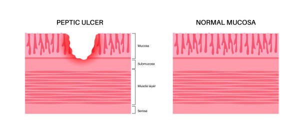 Peptic Ulcer