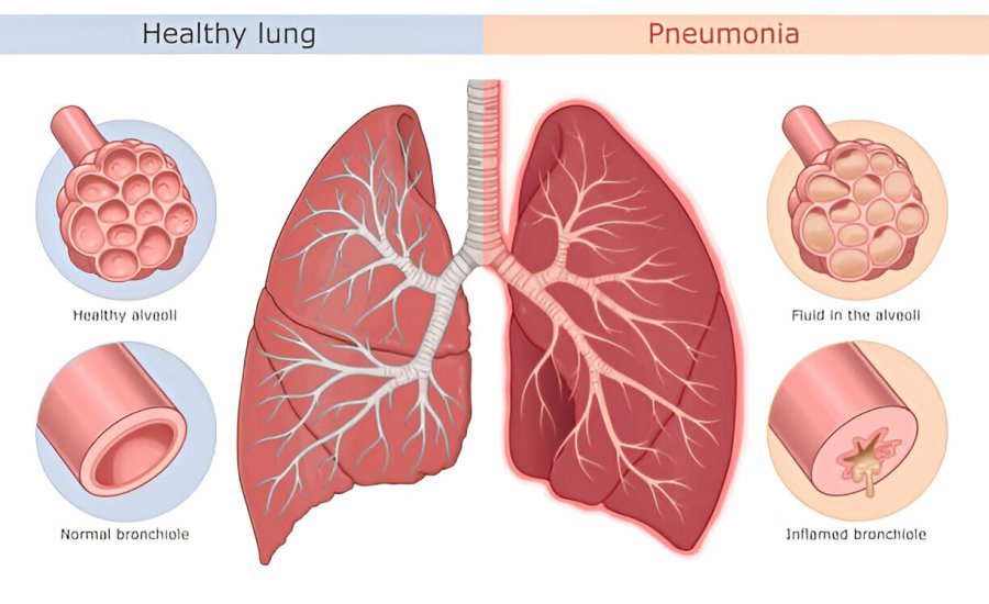 Pneumonia