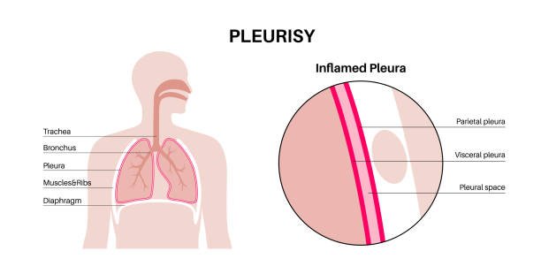 Pleurisy
