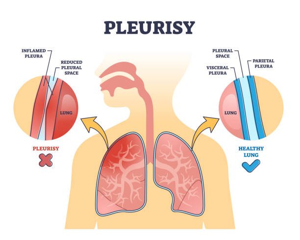 Pleurisy