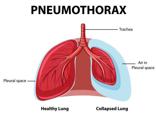 Pneumothorax