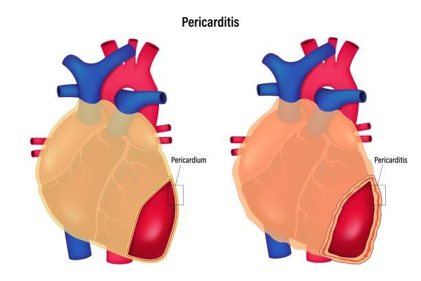 Pericarditis
